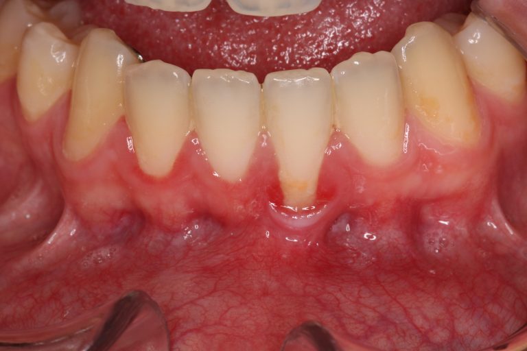 Greffe de gencive esthétique à Besançon